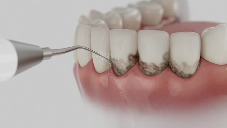 Trusted Wisdom Tooth Removal service in Lawrenceville, GA - Dentist Open Now